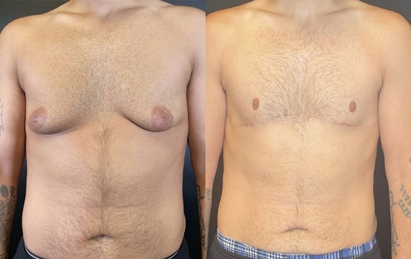 Gynecomastia Surgery