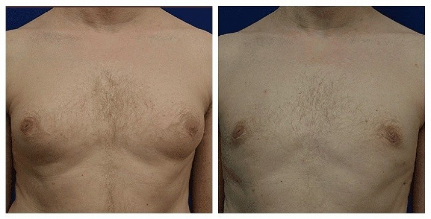 Male Chest Surgery Guide