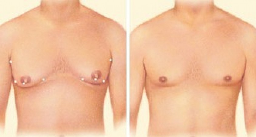 Gynecomastia Surgery Options